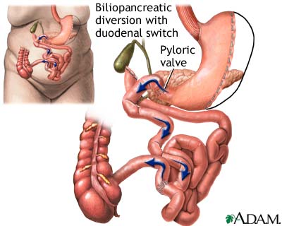 biliopancreatic-diversion-with-duodenal-switch