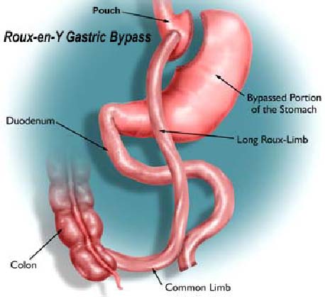 gastric-bypass